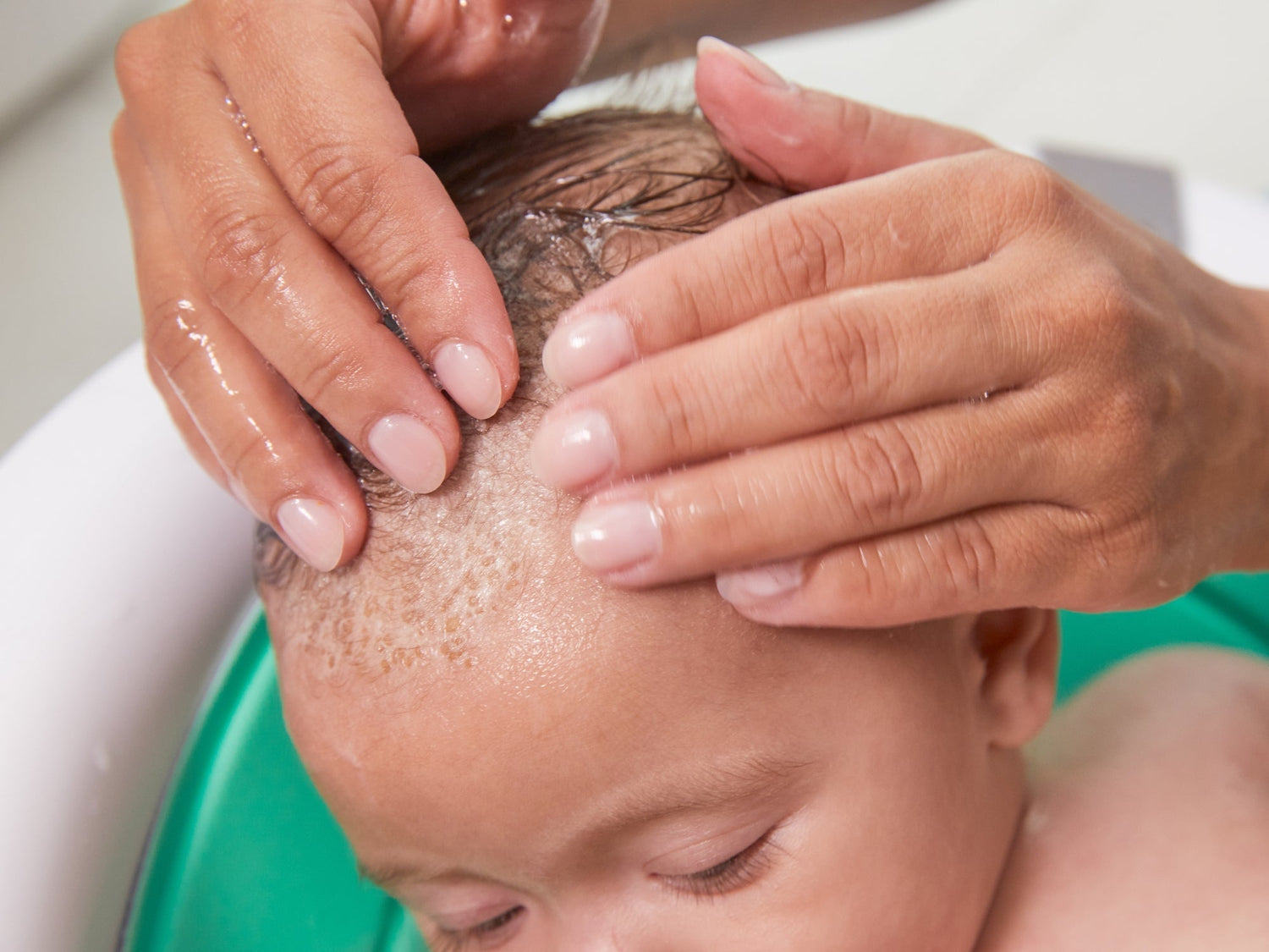 Kopfgneis vs. Milchschorf – wie du’s wirklich unterscheidest